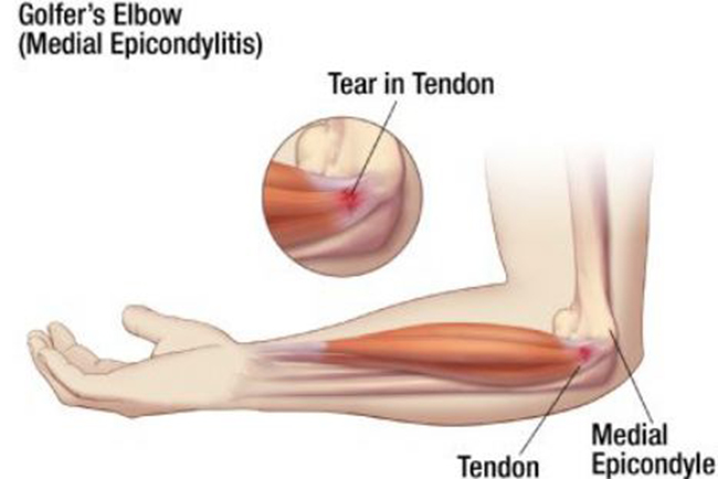 The scourge of 'golfer's elbow'