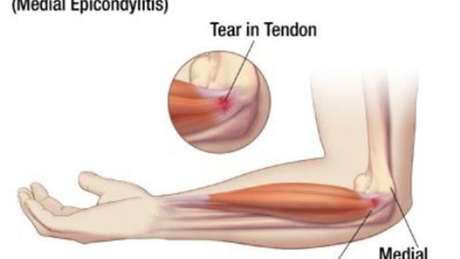 The scourge of 'golfer's elbow'