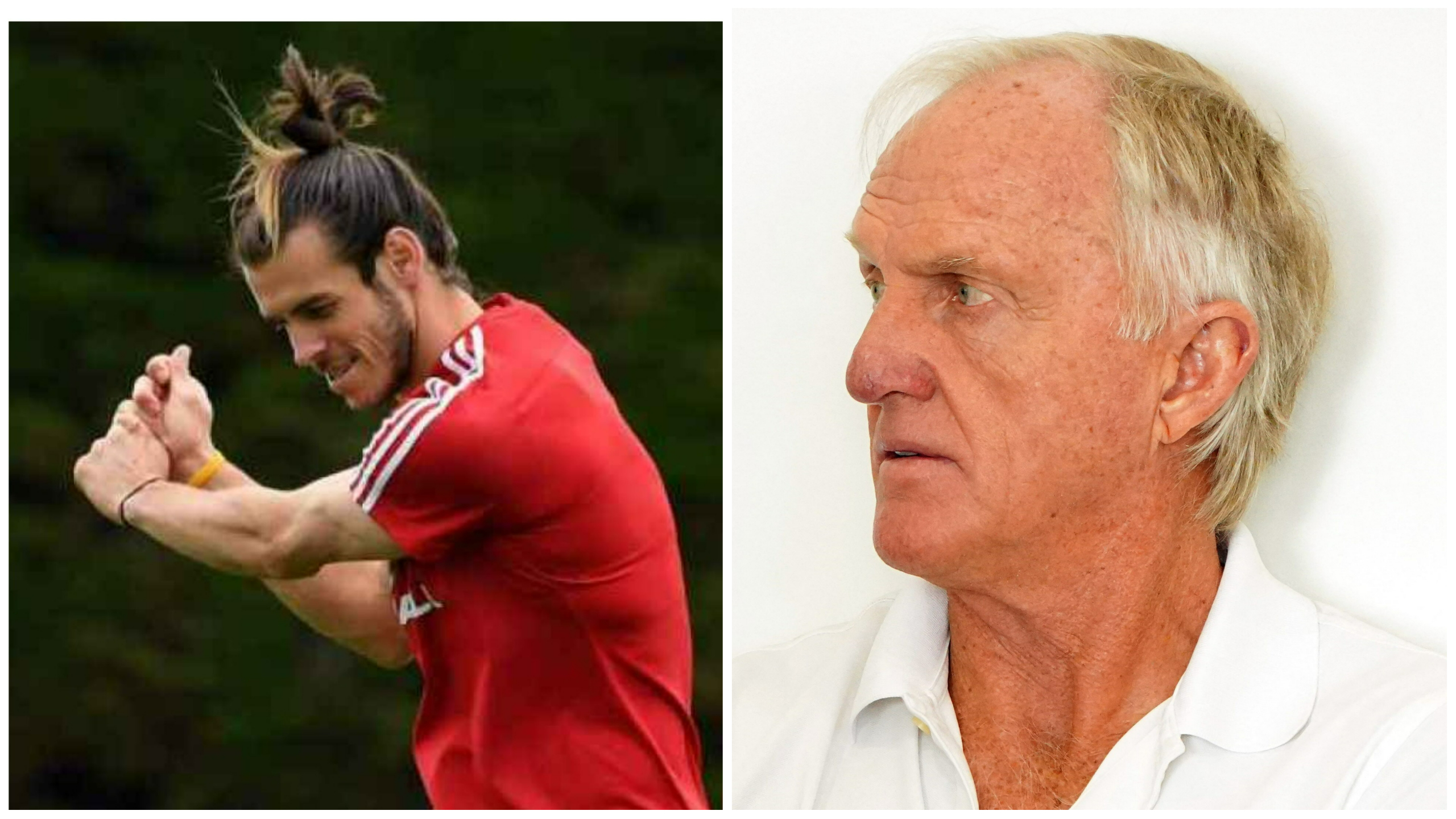 Gareth Bale to receive a hair transplant