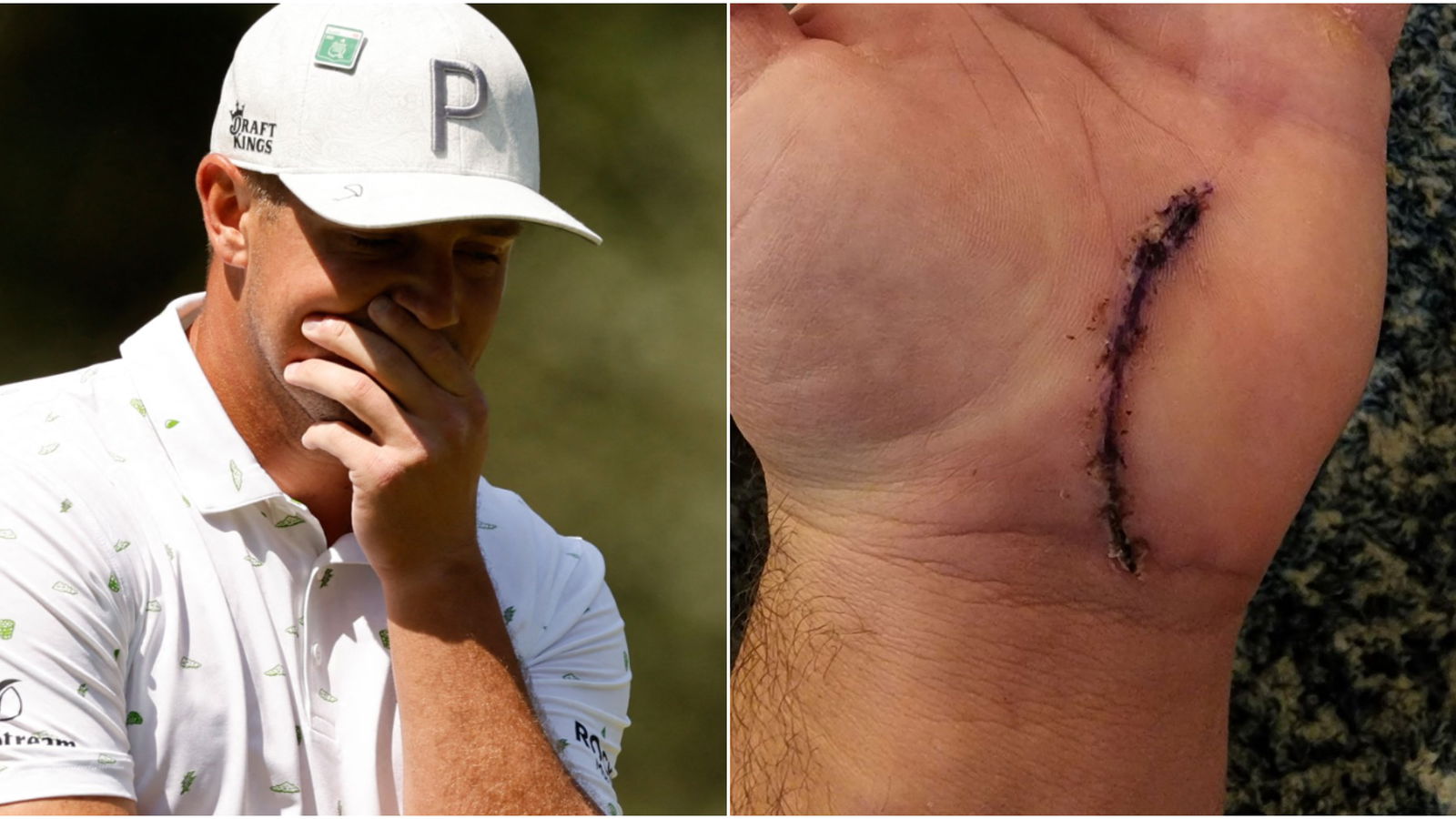 Bryson DeChambeau out of cast, shares image of injured left hand