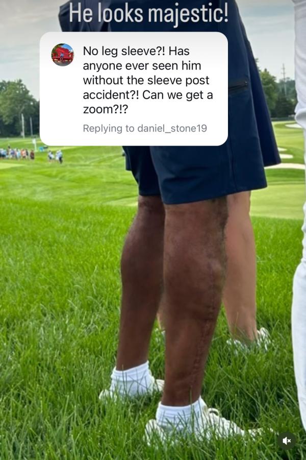 Tiger Woods' scar