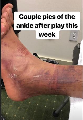 Finau shares picture of mangled ankle post-Masters