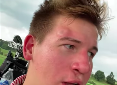 Unlucky golfer gets MASSIVE BUMP on the head after being hit by golf ball