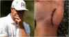 Bryson DeChambeau out of cast, shares image of injured left hand