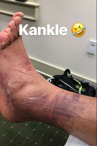 Finau shares picture of mangled ankle post-Masters